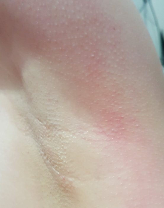 underarm eczema