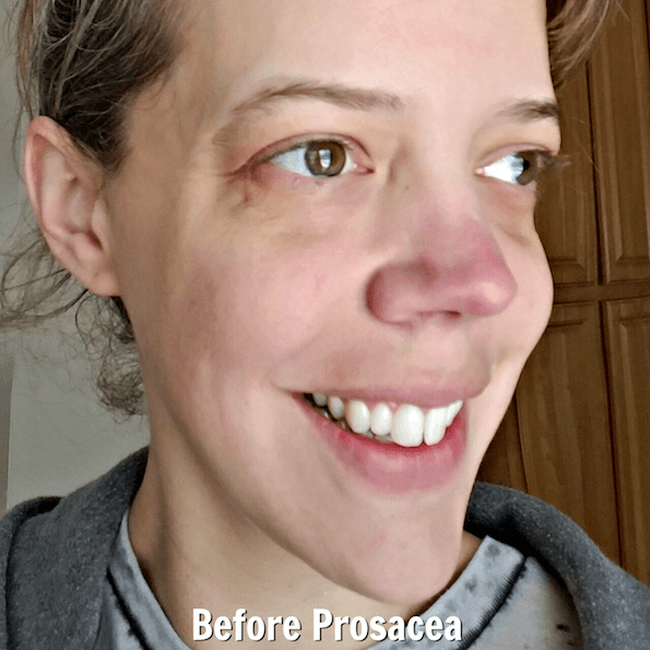 The Red Nose Rosacea Treatment That Really Works